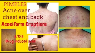 Pimples on chest and back or Acneiform Eruptions aka Drug induced acne  with Teratogenic Drugs [upl. by Aber]