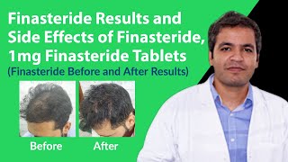 Finasteride Results and Finasteride Side Effects  Finasteride 1mg Tablets Before and After Results [upl. by Rech]