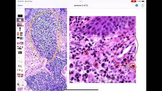 Infection Lecture 2 Syphilis Leprosy Actinomycosis [upl. by Farmer]