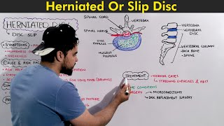 Herniated Disc  Slip Disc Symptoms Causes and Treatments [upl. by Eimarej]