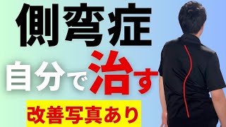 【側弯症治し方】整体や簡単なストレッチでは治らない！手術やコルセットの前に！ [upl. by Arenahs810]