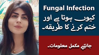 Fungal Infection Of Skin In UrduHindi  Fungal Infection Treatment Fungus Ka Ilaj Dr Deepa Rajani [upl. by Anitrak]