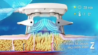 CÓMO FUNCIONA LA CRIOLIPOLISIS  Z Lipo [upl. by Ylrad]