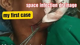 Submandibular amp submental space infection surgery video incision ampdrainageodontogenic infection [upl. by Leonidas]