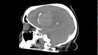 Acute intracerebral haemorrhage 2 [upl. by Ernaldus449]