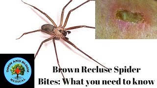 Brown Recluse Spider Bites What you need to know [upl. by Vijar]