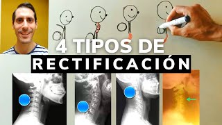 4 Ejercicios para Rectificación Cervical según tu área rectificada [upl. by Carline]