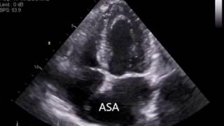 Atrial Septal Aneurysm ASA [upl. by Tandi]