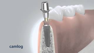 Dental animation Camlog Implant System  3D Animation Medizin [upl. by Dyl]