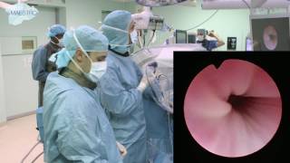 Cystoscopy and placement of guidewire [upl. by Aennil]