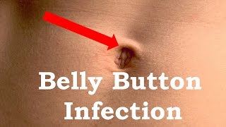 How to Treat Belly button Infection [upl. by Adnoma]