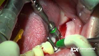 Dental Implantat Zahn 36 und 37 [upl. by Leonard273]