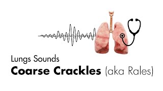 Coarse Crackles Rales  Lung Sounds  Medzcool [upl. by Berner753]