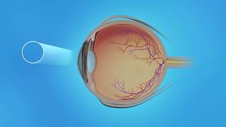 Cystoid Macular Edema Medication Injections [upl. by Carpio]