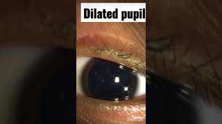 Dilated Pupil  pupil [upl. by Tavish]