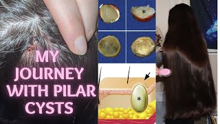 My Journey with Pilar Cysts on my Scalp  Removal  Aftercare VLOG [upl. by Martella]