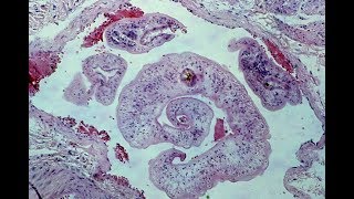 Schistosomiasis  Pathology mini tutorial [upl. by Ellicul]