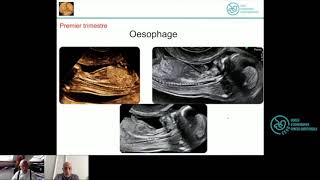 Tube Digestif Normal  Formation Echographie Obstétricale Maroc [upl. by Zita]