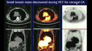 PET CT Scan [upl. by Avlis]