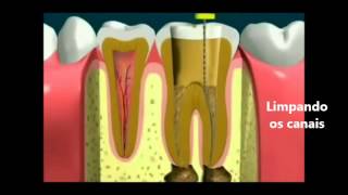 O que é Endodontia [upl. by Meg]