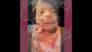 Katierae Trisomy 18 Awareness [upl. by Candy]