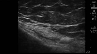 Ultrasound guided pes anserine bursitis injection [upl. by Gonnella]