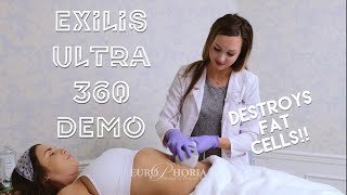 EXILIS ULTRA DEMONSTRATION BODY  Exilis Ultra 360 Experience at EuroPhoria [upl. by Logan]