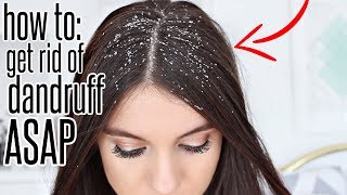 How To Get Rid Of Dandruff After ONE WASH [upl. by Aivitnahs]