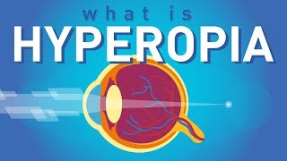 What is Hyperopia Farsightedness [upl. by Ema953]