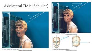 Radiographic Positioning of the TMJs [upl. by Sadoc916]