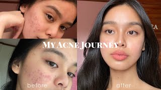 How I Cleared my Acne somehow PHILIPPINES  Lj Torres [upl. by Ahsiei]