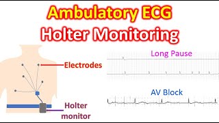 Ambulatory ECG Holter Monitoring [upl. by Riancho171]