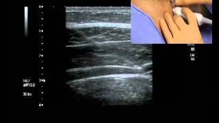 Transverse Abdominis Plane Block ultrasound guided [upl. by Petie959]