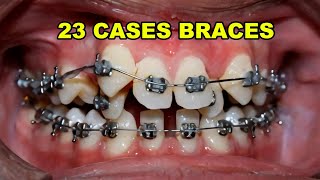 23 Case Braces Transformation [upl. by Bac264]