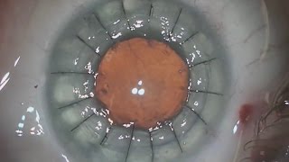 Cornea transplant on an eye with prior RK surgery in 3 minutes  Shannon Wong MD 6516 [upl. by Ahsinyt382]