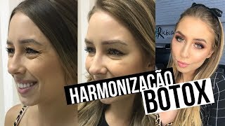 PREENCHIMENTO DE OLHEIRAS  ANTES x DEPOIS harmonização facial e botox [upl. by Elleivap]