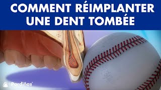 Avulsion dentaire – Comment réimplanter une dent tombée © [upl. by Nangem]