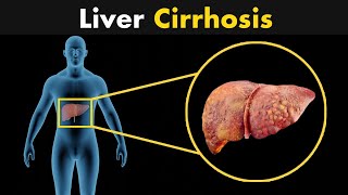 What is liver cirrhosis  Symptoms Diagnosis and treatment 3D Animation [upl. by Crysta]