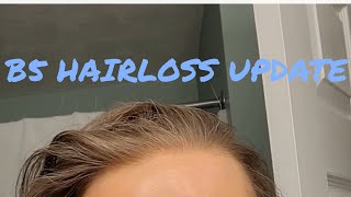 UPDATE VitaminB5Aggravated Hairloss Treatment that is WORKING 🎉 🥳 [upl. by Locke]