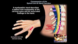 Compression of the Spinal Cord amp Hand Function  Everything You Need To Know  Dr Nabil Ebraheim [upl. by Bak]