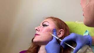 Acne Scar Treatment with Bellafill dermal filler in Seattle at Well Medical Arts [upl. by Ojyram225]