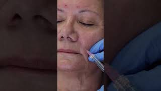 Botox on Forehead Nasolabial Folds amp Marionette Lines  Watch Procedure by Top Botox MD [upl. by Enilaf549]