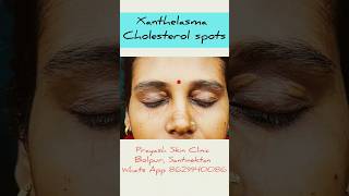 Xanthelasma before after chemical cautery drgsmukherjee xanthelasma cholesteroldepositsonskin [upl. by Yager]