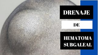 Drenaje de Hematoma Subgaleal [upl. by Beattie153]