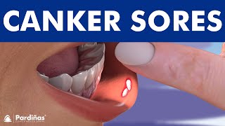 CANKER SORE  Treatment and mouth ulcer causes © [upl. by Sadonia57]