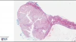 Histopathology AdrenalCortical adenoma [upl. by Jabin905]