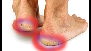 How to Repair Cracked And Dried Feet At Home Fast  Dry Cracked Heels Treatment [upl. by Melvina]