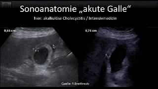 DProbleme Gallenblase und wege Worauf bd fokussierten Sonographie achten von Claudia Schrader [upl. by Macgregor]