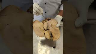 LIVERQuadrate ampCaudate Lobes shorts anatomy shortsyoutubeindia shortsyoutube liver hepatic [upl. by Aerdnaeel516]