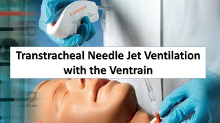 Transtracheal Needle Jet Ventilation TTJV with the Ventrain [upl. by Hafeenah]